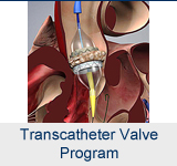 Transcatheter Valve Program