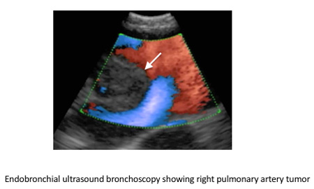 ultrasound bronchoscopy