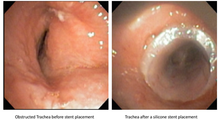 before and after trachea