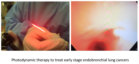 photodynamic therapy for lung cancer